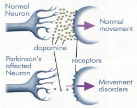 Normal Neuron Parkinson's affected Neuron Dopamine Movement Disorders - Best Personal Trainers and Nutrition Consulting in Dubai AbhiiFit